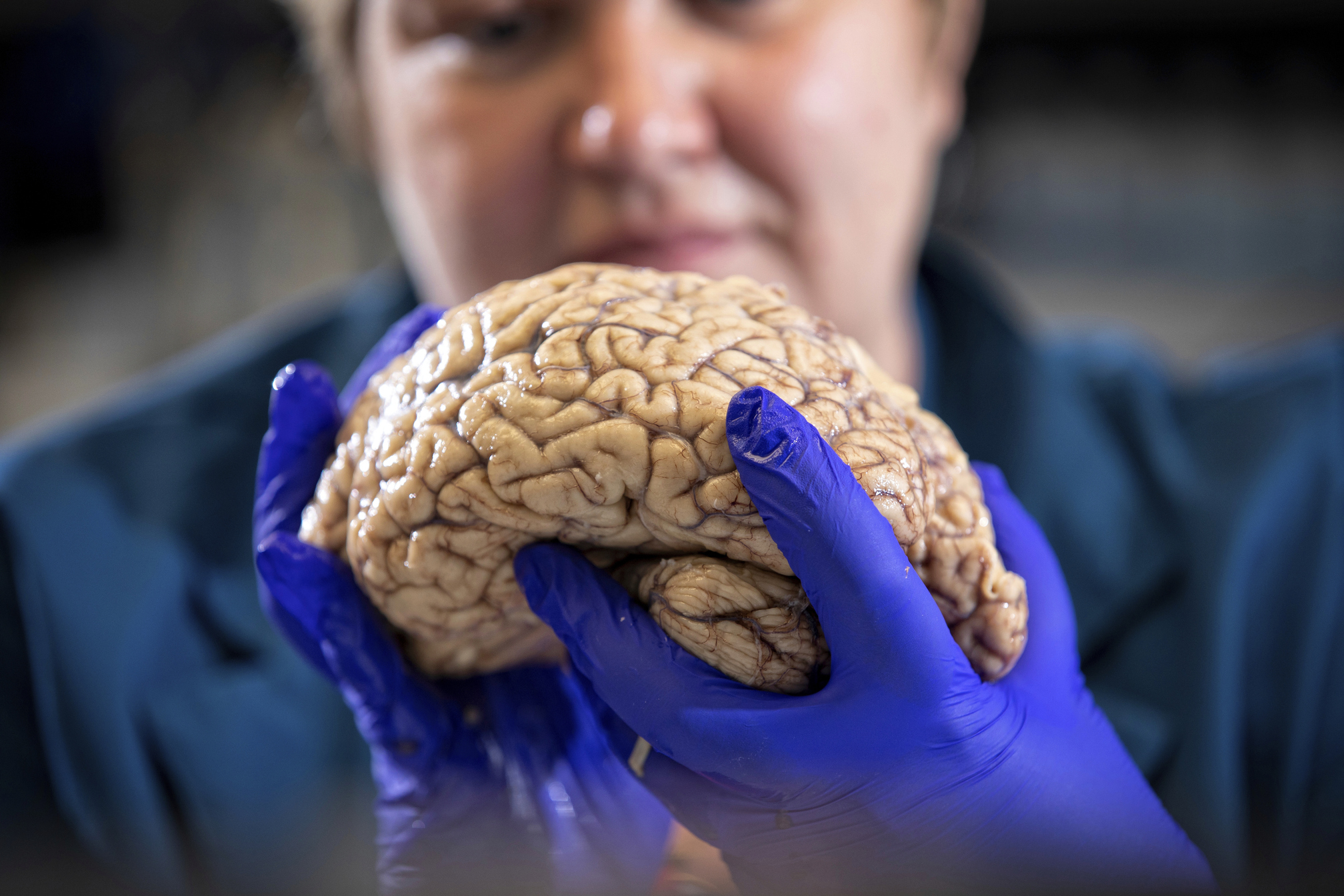 Пациенты с поражением мозга. Головной мозг старость. Болезнь Альцгеймера мозг.