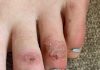‘COVID toes,’ other rashes latest possible rare virus signs