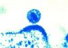 Study identifies virulent HIV variant unrecognized for years