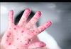 Aruba has no cases of Monkeypox