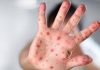 First positive Monkeypox case in Aruba