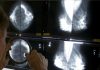 Breast cancer survivors may not need so many mammograms after surgery, UK study suggests