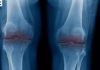 The end of the knee replacement? Scientists hail lab-grown cartilage breakthrough