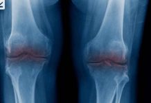 The end of the knee replacement? Scientists hail lab-grown cartilage breakthrough